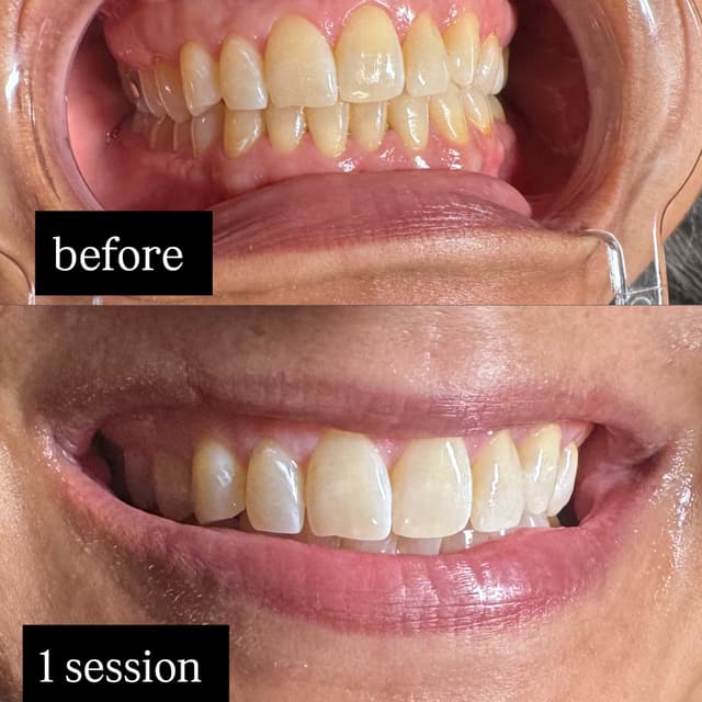 Teeth Lightening Membership at New Moon Spa Studio in Universal City, TX
